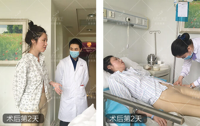 小岳岳呀大腿抽脂減肥+北京美萊吸脂瘦腿案例