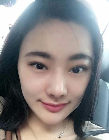 鄭州美萊整形醫院案例劉雨婷