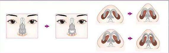 鼻頭縮小術整形是怎樣的