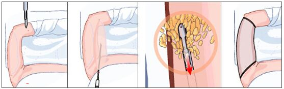 深圳去哪里做吸脂瘦腰效果比較好