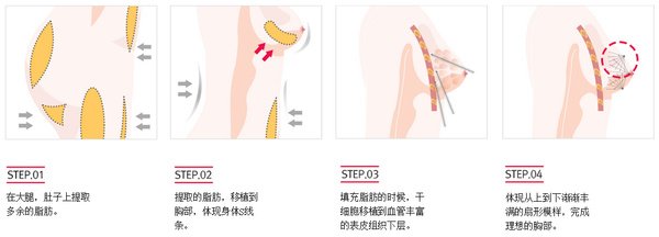 自體脂肪豐胸