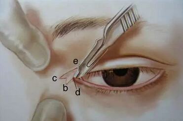 開內(nèi)眼角和開外眼角區(qū)別有哪些