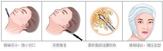 面部吸脂術后臉部出現的硬塊怎么消除呢