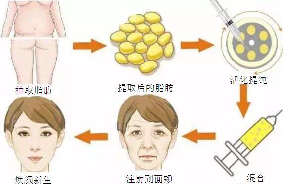 杭州自體脂肪填充面部術后會出現下垂現象嗎