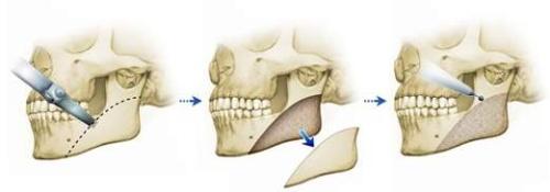 下頜角手術