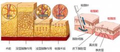 沈陽做抽脂減肥術后有哪些護理工作