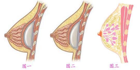 豐胸手術