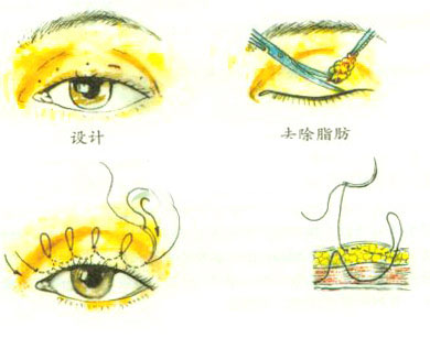 沈陽做微創雙眼皮手術后的效果怎么樣