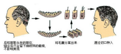 成都植發