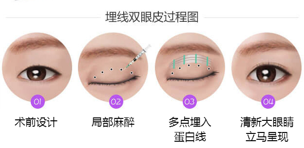 埋線雙眼皮的效果可以維持多少年呢