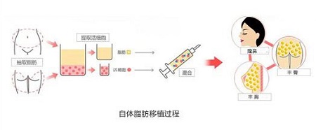 注射玻尿酸填充鼻唇溝