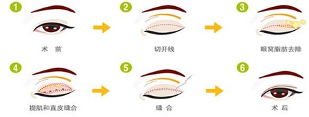 切開雙眼皮和埋線雙眼皮