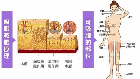 吸脂瘦臀