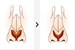 自體軟骨組織隆鼻有哪些優(yōu)點(diǎn)？