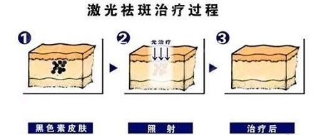 激光祛斑后