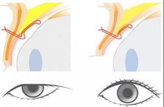上瞼下垂矯正手術