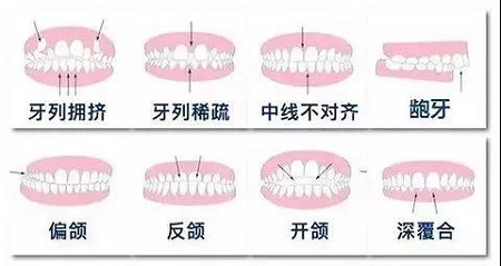 帶你一分鐘走出牙齒矯正誤區