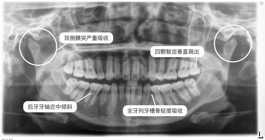 牙齒矯正