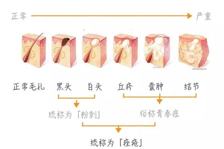 擠痘竟然被送進ICU！你的痘痘還好嗎？