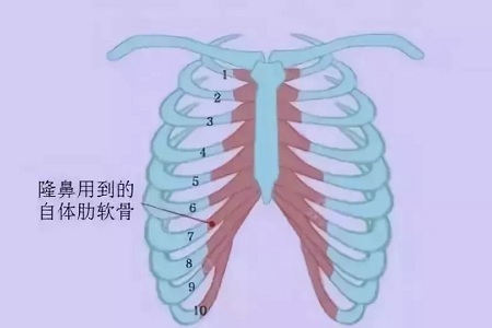 什么，隆鼻方式竟然有這么多種？