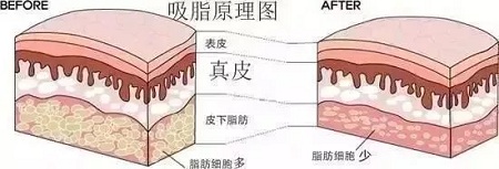 醫(yī)美白皮書：吸脂等于減肥嗎？