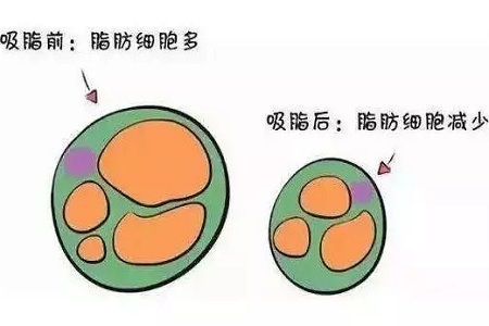 關于吸脂那些不能說的秘密，今天要在這里一次說完！