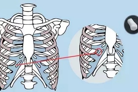 糾結(jié)！鼻頭太圓想塑形是用肋軟骨還是耳軟骨好？