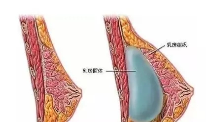 自體脂肪or假體隆胸，我到底應該怎么選？