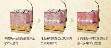 水光，打1次和4次究竟有多大區(qū)別？