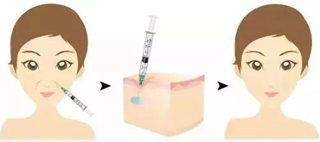 用玻尿酸治療鼻唇溝，一定要注意這種情況！