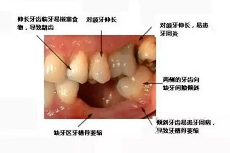 牙齒缺失時，選烤瓷牙還是那種？