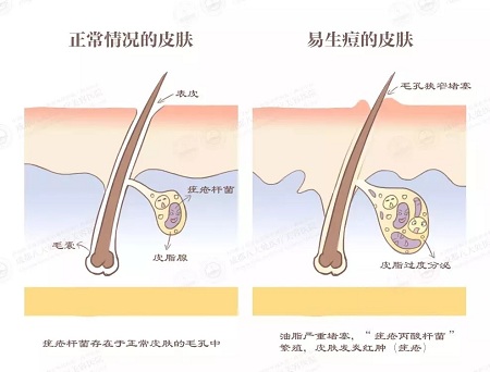 正常情況的毛孔VS易生痘的毛孔