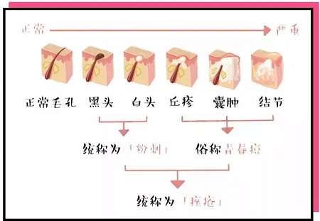 痤瘡的分類