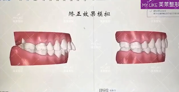 天津美萊口腔·專業口掃 預見矯正效果