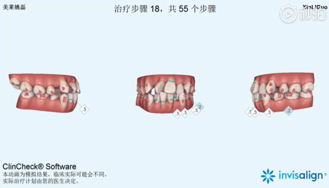 南京美萊口腔全景側位片，拍照取模，動畫方案設計