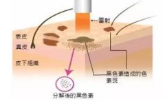 西安整形醫院做點陣激光多少錢，一次有效果嗎