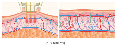 超光子+水光，“撐起”皮膚彈、潤、緊